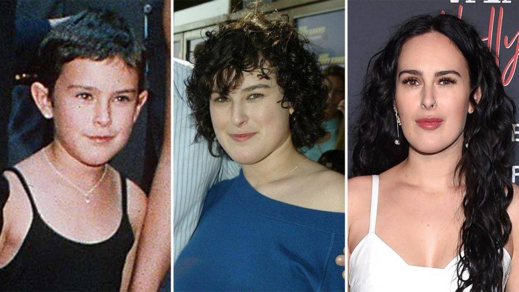 Rumer Willis Plastic Surgery