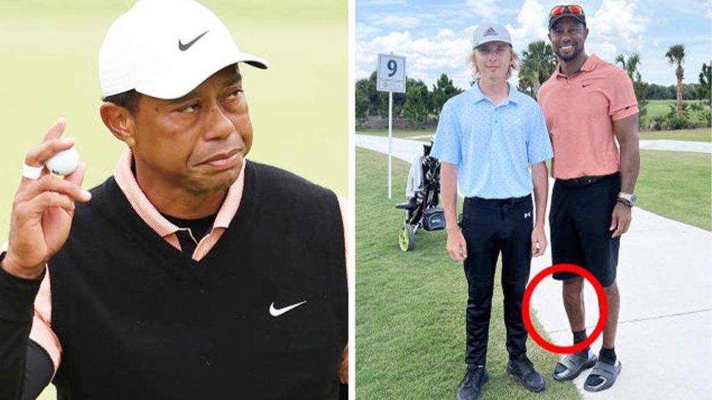 What Happened to Tiger Woods Leg in Accident?